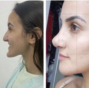 Pré-operatório e pós-operatório de mentoplastia e rinoplastia